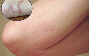 Dấu hiệu bệnh Sán Chó thường gặp